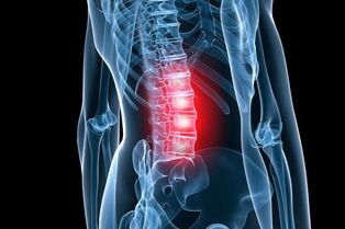 lumbar spine osteochondrosis