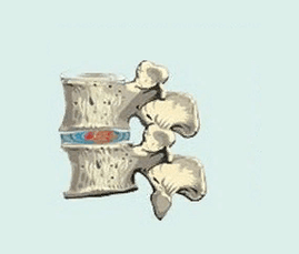 stage of osteochondrosis